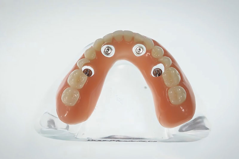 a full arch of teeth with 4 holes for dental implants to be placed onto the jaw