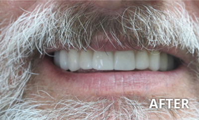 before and after