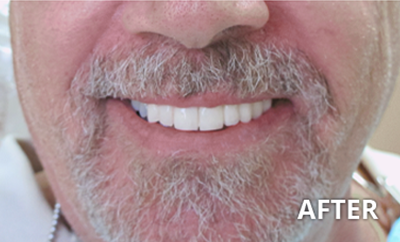 before and after