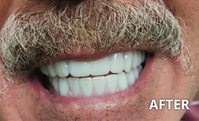 before and after