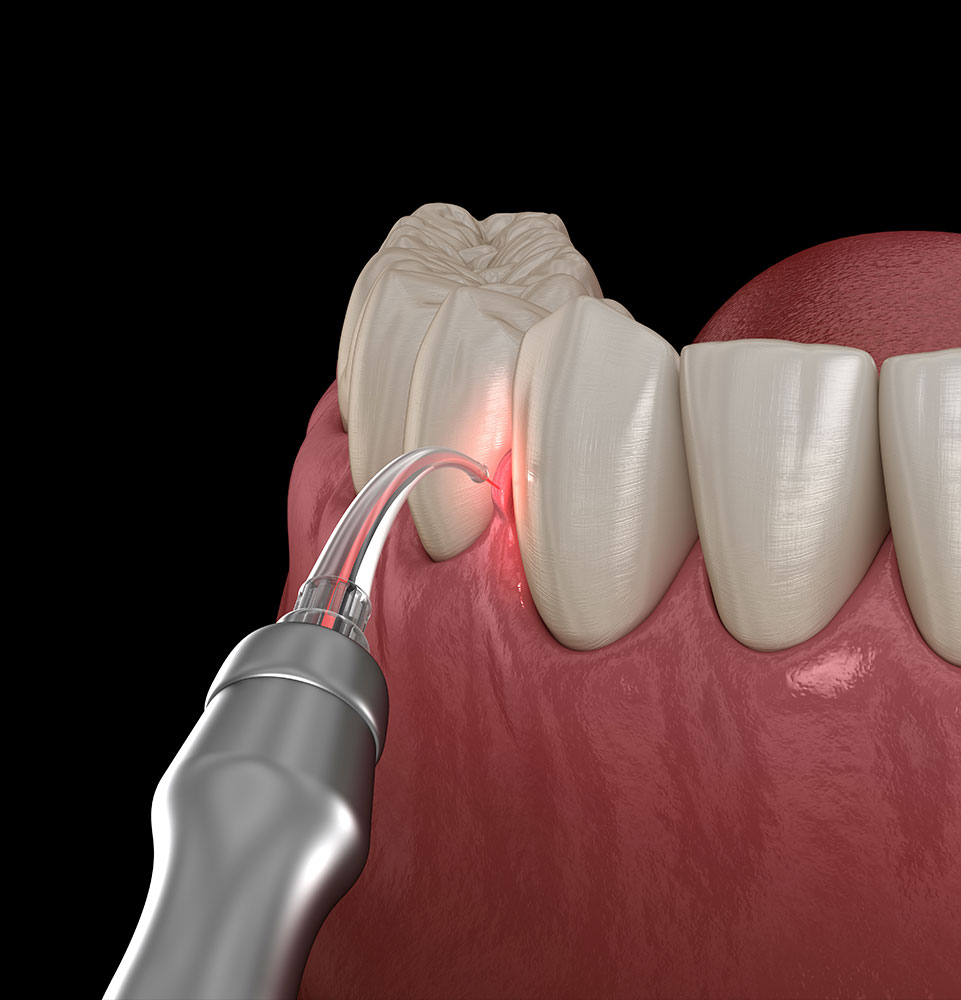 LANAP procedure 3d rendering