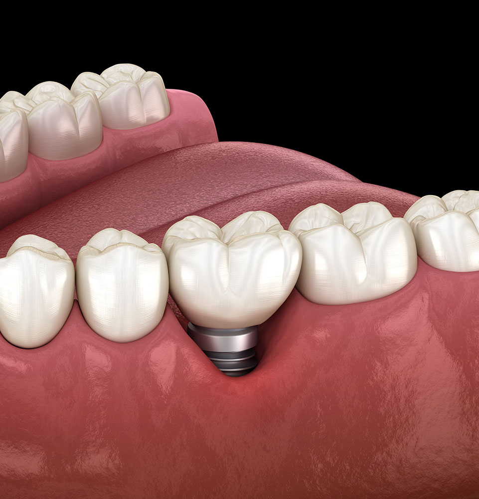 peri-implantitis