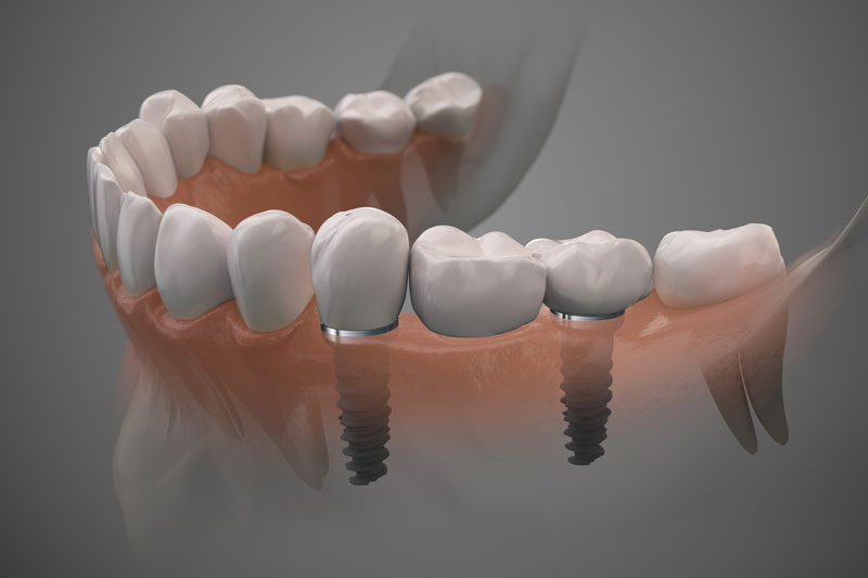 2 single dental implants with 2 crowns on top of the implants