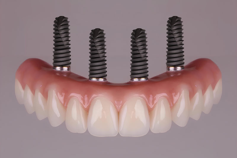 all on 4 dental implants with 4 implants on the full arch of teeth