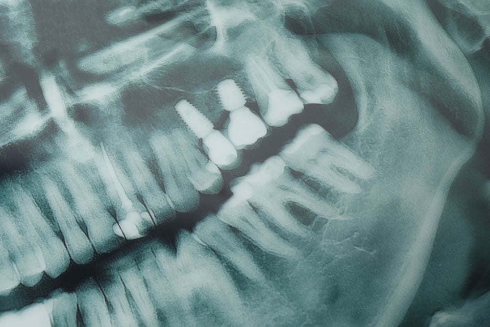 A dental X-ray displays a side profile of the jaw with two visible dental implants and multiple natural teeth. The implants are shown as bright, screw-shaped structures located near the molars.